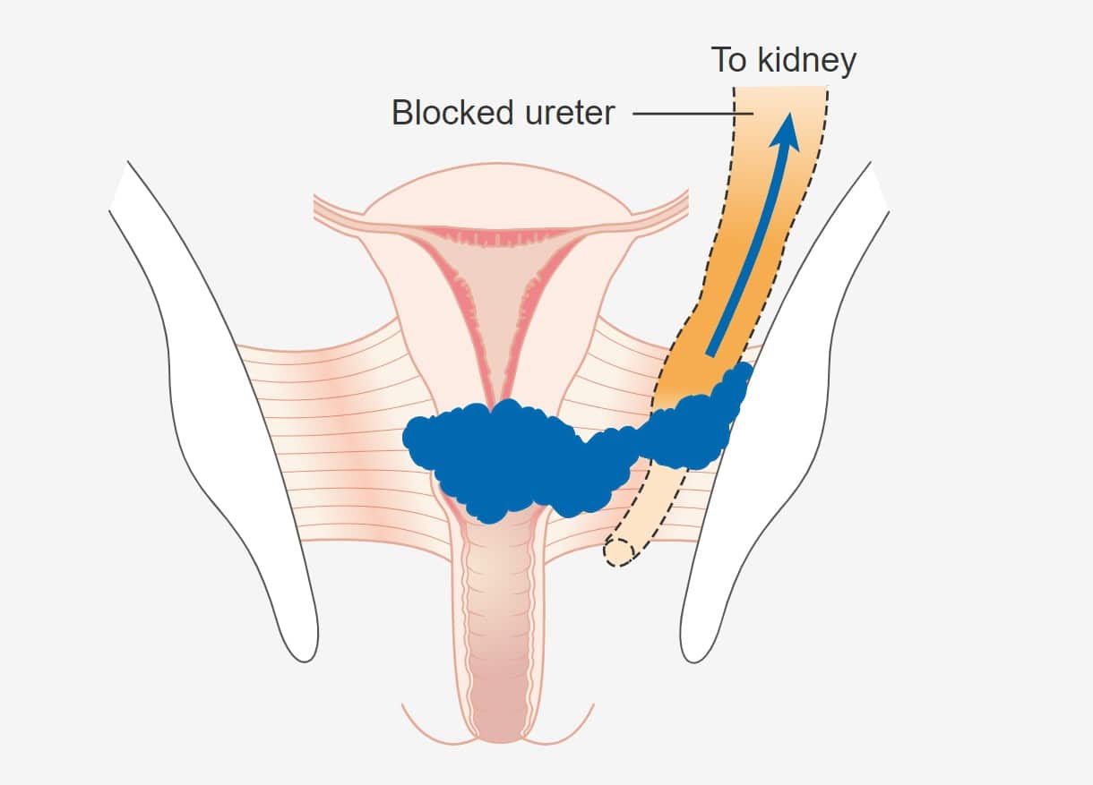 Eliminating cervical cancer