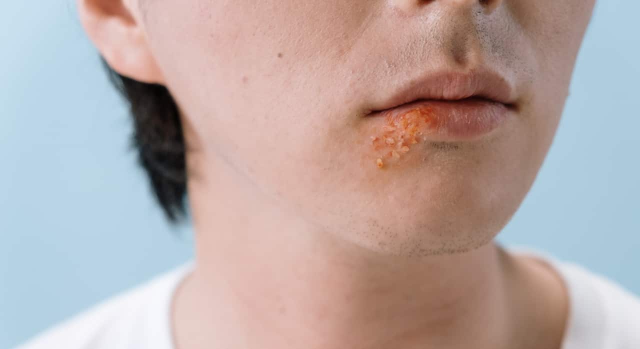 Shingles