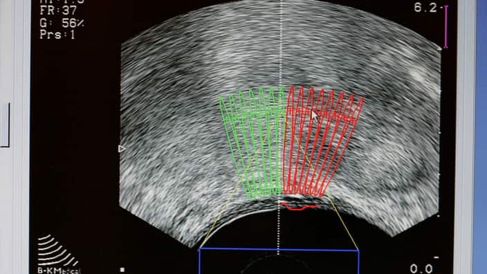 Prostate Cancer