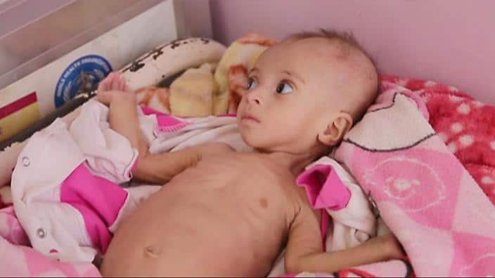 child victim in Yemen
