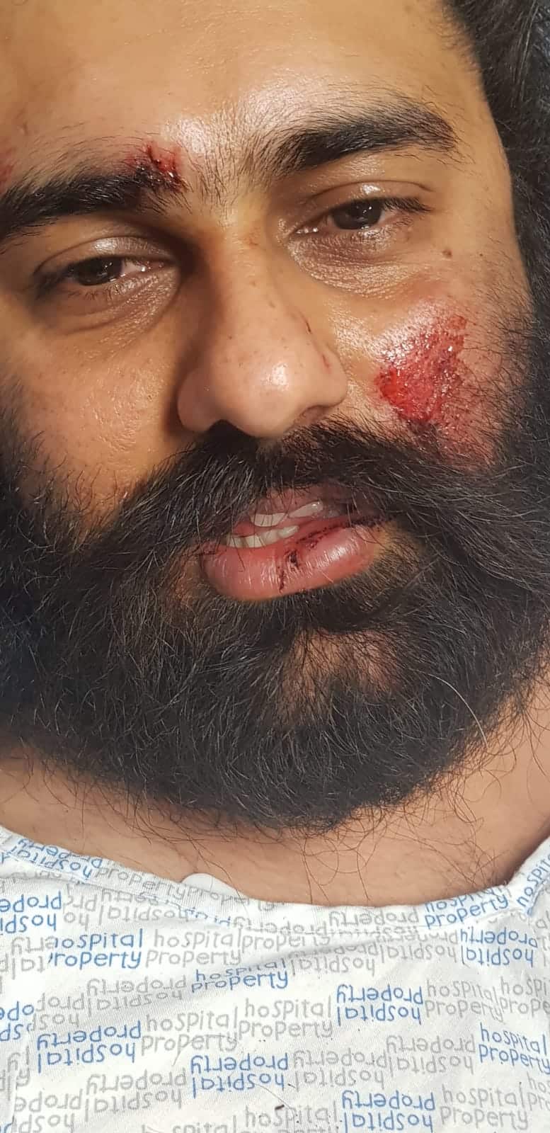 Talvinder face injuries