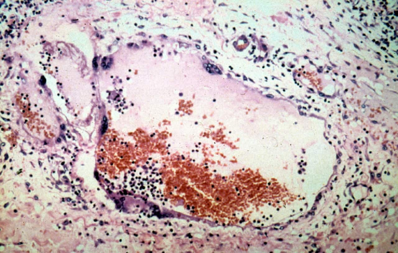 Nipah virus