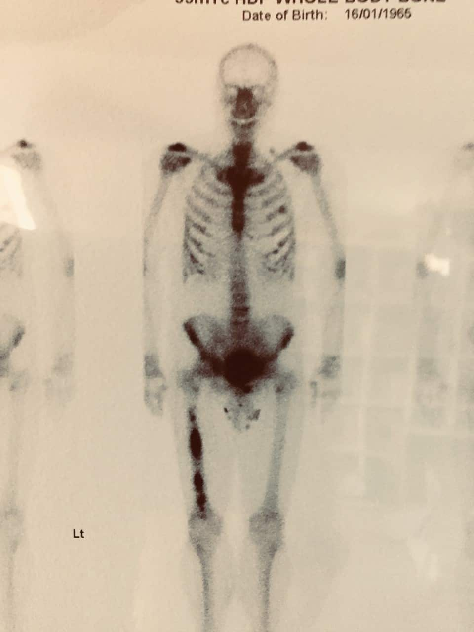 Ben's bone scan on diagnosis. There is a tumour in the right femur and left rib